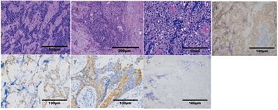 The whole treatment process and thinking of a patient with NUT carcinoma of the parotid gland: a case report